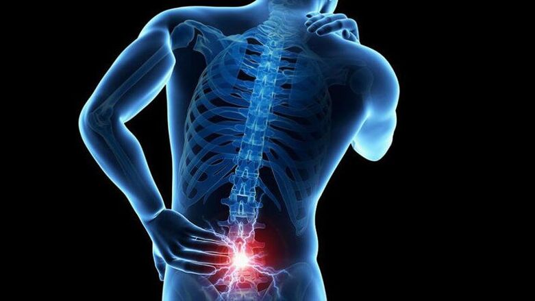Symptoms of lumbar osteochondrosis